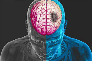 Последствия геморрагического инсульта головного мозга